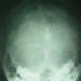 Image result for Occipital Cyst