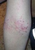 Image result for Allergy Rash Legs
