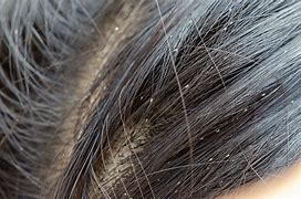 Image result for What Do Lice Bugs Look Like