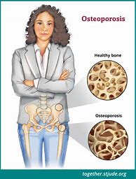 Image result for Healthy Bone vs Osteoporosis