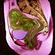 Image result for Uterine Fibroid Tumors