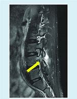 Image result for Axial T2 MRI Pars Defect
