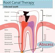 Image result for Abscess Wisdom Tooth Extraction