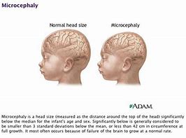 Image result for Microcephaly