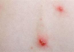 Image result for Chicken Pox Day 1