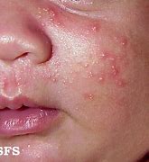 Image result for Baby Acne vs Eczema