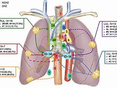 Image result for 2 Cm Lymph Node