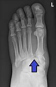 Image result for Lisfranc Fracture Lateral View