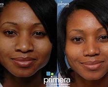 Image result for African American Rhinoplasty Before and After