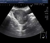 Image result for Cervical Fibroid Ultrasound