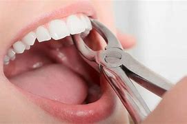 Image result for Tooth Extraction Recovery