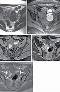Image result for Adnexal Cyst CT Scan