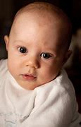 Image result for Baby Born with Anencephaly