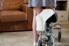 Image result for Woman Plaster Cast