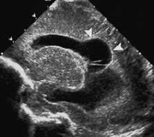 Image result for Porencephalic Cyst Ultrasound