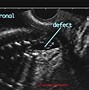 Image result for Myelomeningocele Meningocele Fetal Ultrasound