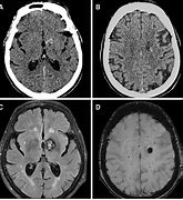 Image result for Basal Cell Scalp Lesion