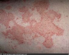 Image result for Itchy Eczema