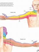 Image result for C-spine Radiculopathy