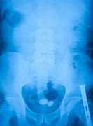 Image result for Stone in Urinary Bladder
