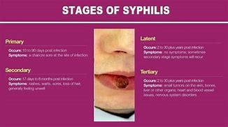 Image result for Stage 1 Syphilis Rash