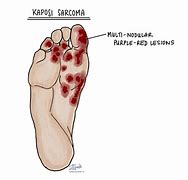 Image result for Kaposi Sarcoma