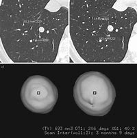Image result for 2 Millimeter Lung Nodule