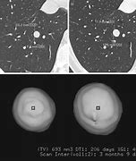 Image result for 1 7 Cm Nodule in Lung