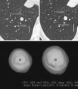 Image result for Lung Nodule Size Chart