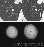 Image result for 16Mm Lung Nodule