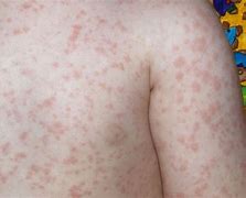 Image result for Fifth Disease Rash Pictures in Adults