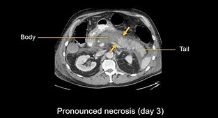 Image result for Pancreatitis CT Findings