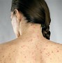 Image result for Eczematous Dermatitis Pictures
