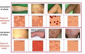 Image result for Common Skin Diseases