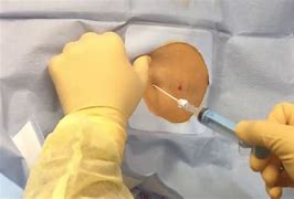 Image result for Ir Drain for Abdominal Abscess