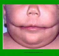 Image result for Craniofacial Anomalies