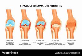 Image result for Rheumatoid Arthritis Pain Scale