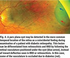 Image result for Peripheral Retina