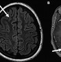 Image result for Brain On Fire Disease