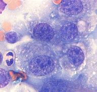 Image result for Transitional Cell Carcinoma Microscope