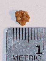 Image result for Kidney Stone Look Like