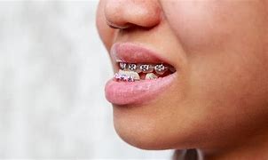 Image result for Protruding Lower Jaw