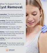 Image result for Adnexal Cyst Size Chart