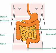 Image result for Picture of Cancer in Small Bowel