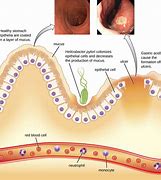 Image result for Stomach with Fibroids