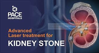 Image result for Chronic Kidney Stones