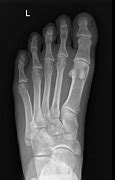 Image result for Pseudo-Jones Fracture
