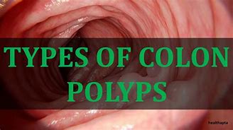 Image result for 5 mm Polyp in Colon