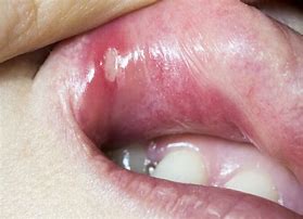 Image result for Oral Ulcer