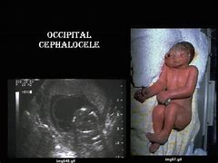 Image result for Encefalocele Occipital